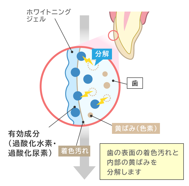 歯医者でのホワイトニングの仕組み図