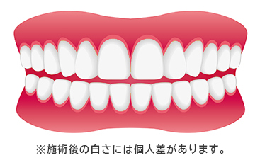 歯医者でのホワイトニング後の歯