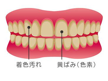 ホワイトニング前の歯