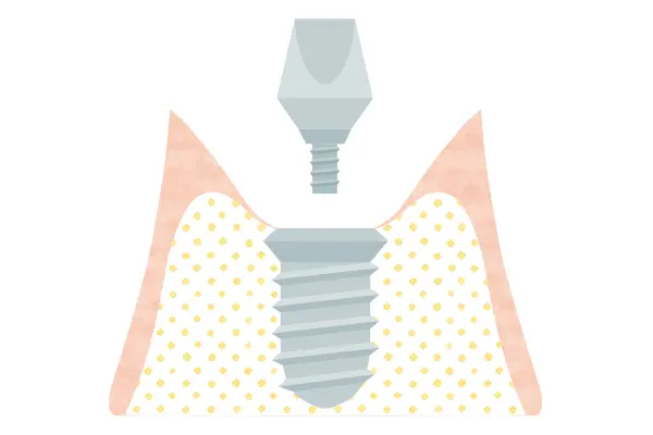 人工歯を装着するアパットメント