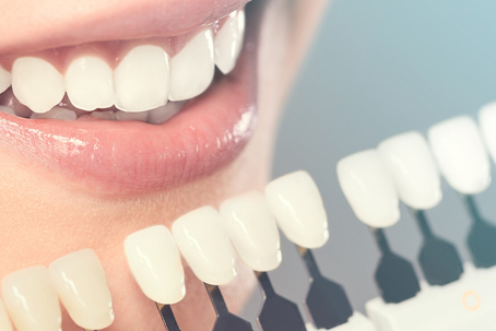 歯のホワイトニングの種類