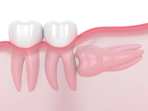 横向きの親知らずのイラスト