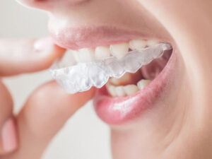 マウスピース矯正中のホワイトニング