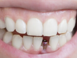 仮歯のないインプラント体