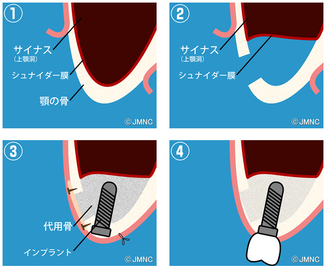 サイナスリフト