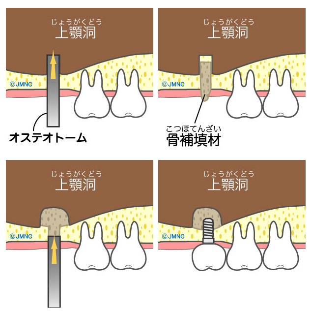 ソケットリフト