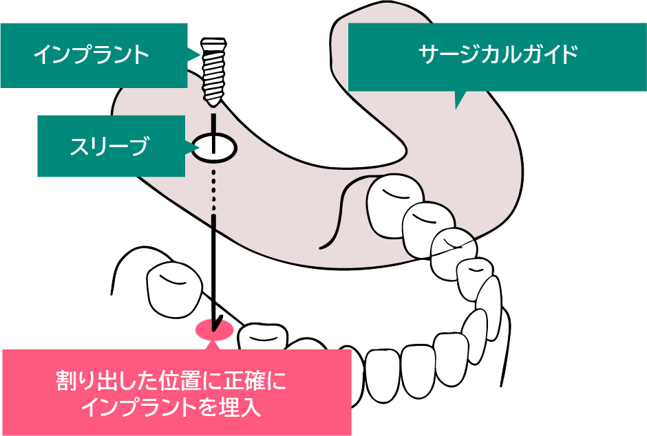 サージカルガイドの役割の図